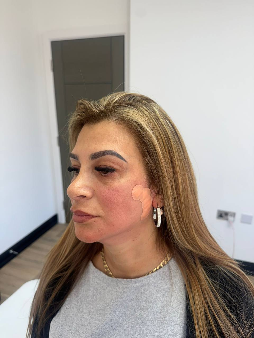 PDO Threads · Jawline & Neck — after